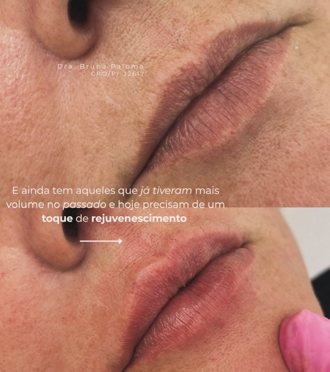 Antes e depois de rejuvenescimento labial realizado pela Dra. Bruna Paloma